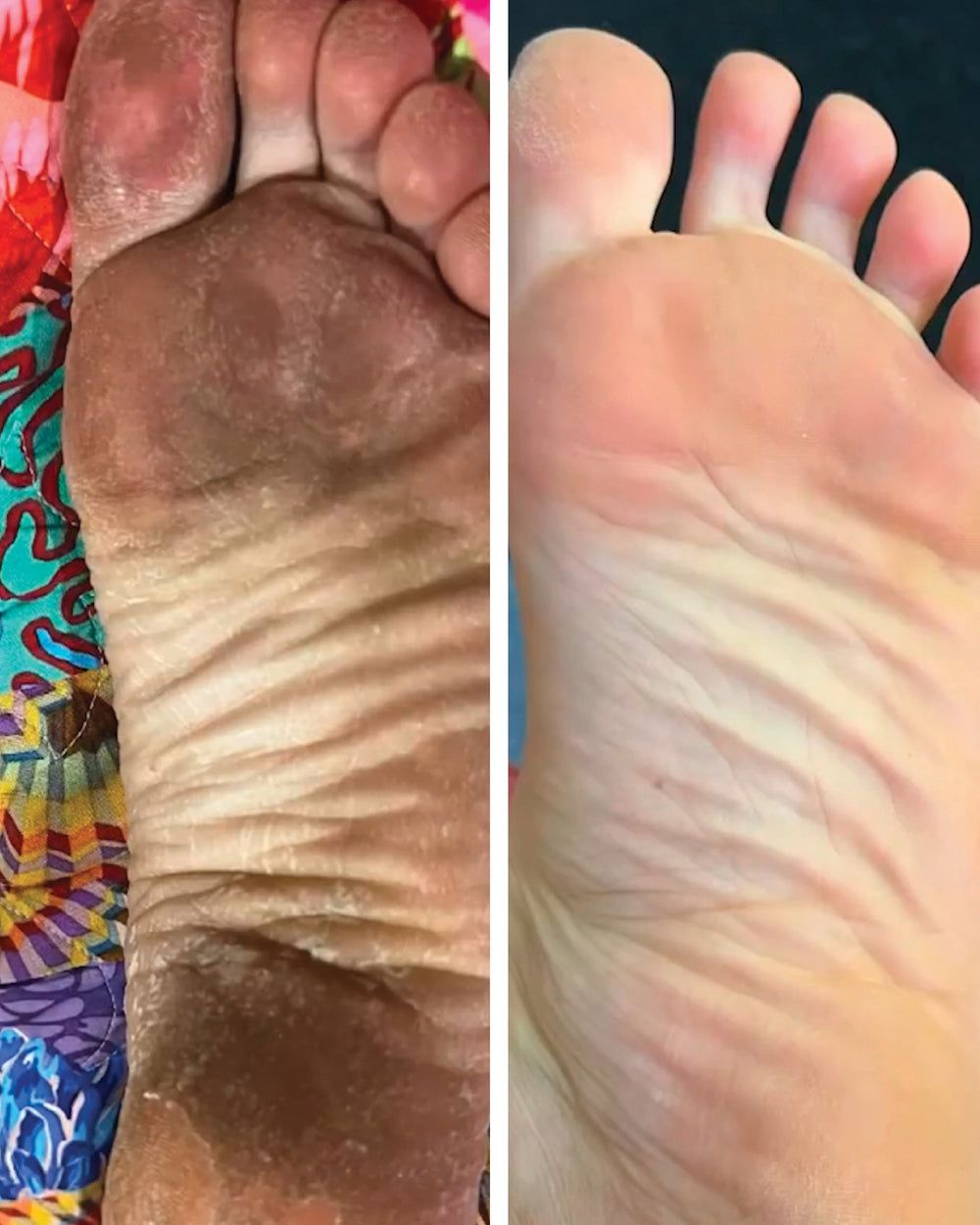 Foot Peel